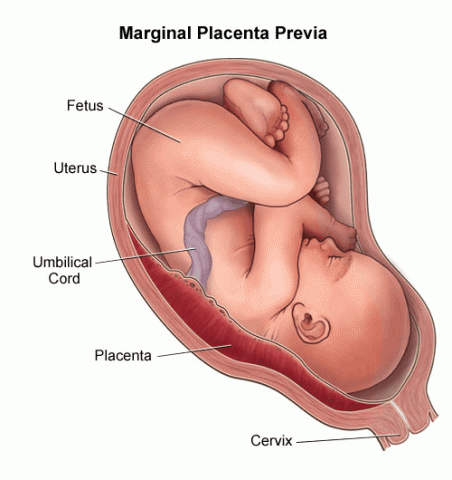 Placenta previa